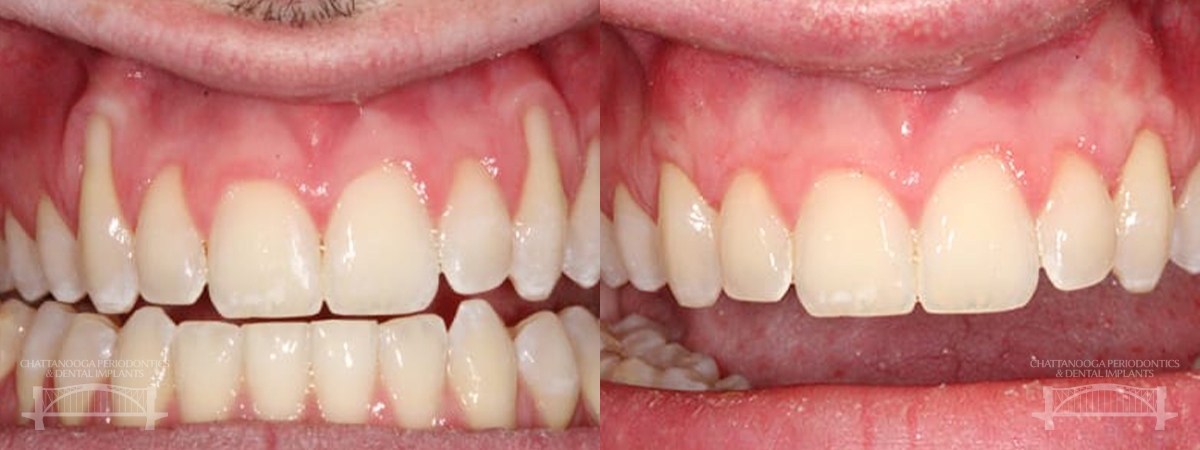 Chattanooga connective tissue graft 1 chattanooga periodontics dental implants