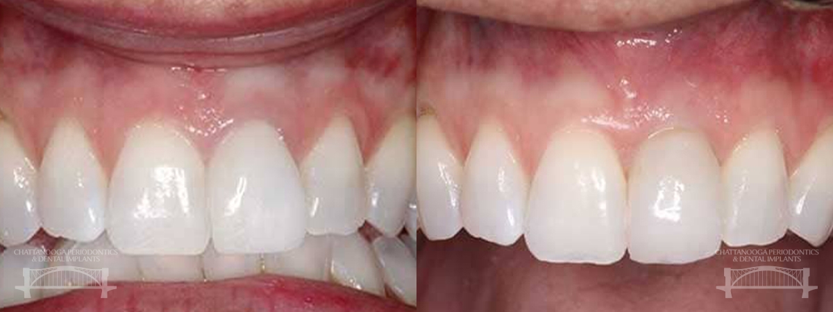 Chattanooga dental implants 1 chattanooga periodontics dental implants