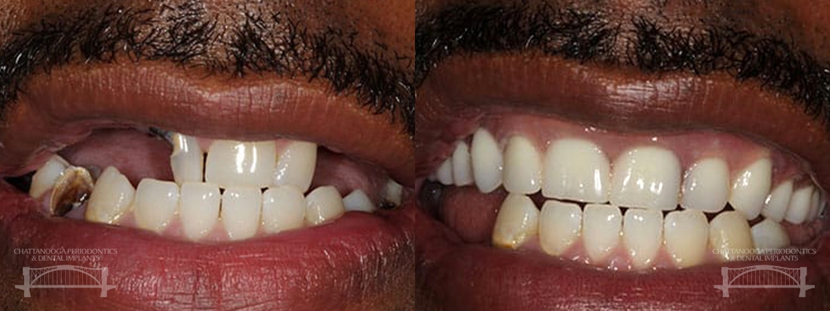 Chattanooga hybrid dental implants 1 chattanooga periodontics dental implants