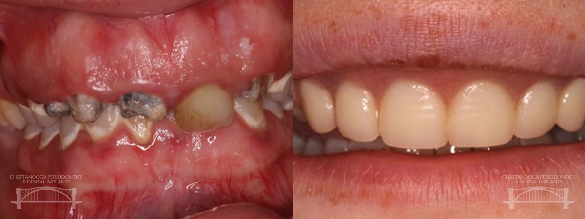 Chattanooga implant overdenture 1 chattanooga periodontics dental implants
