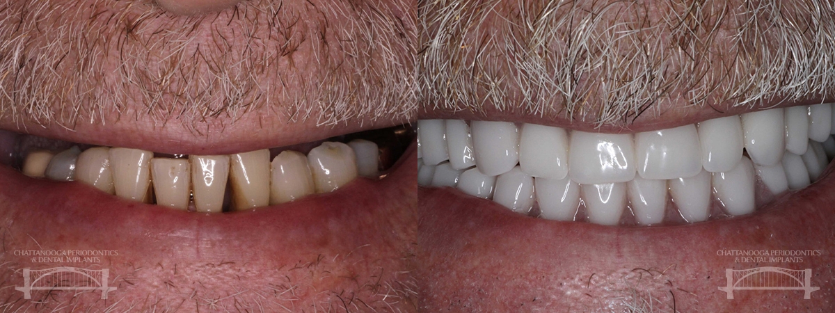 Chattanooga implant overdenture 2 chattanooga periodontics dental implants