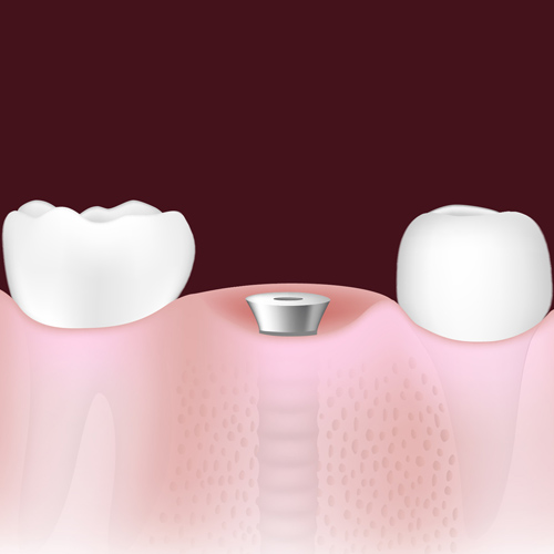 Implant placed model at dr felts chattanooga tn chattanooga periodontics dental implants