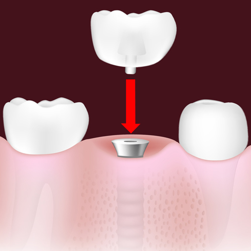 Process of placing a crown model chattanooga tn chattanooga periodontics dental implants