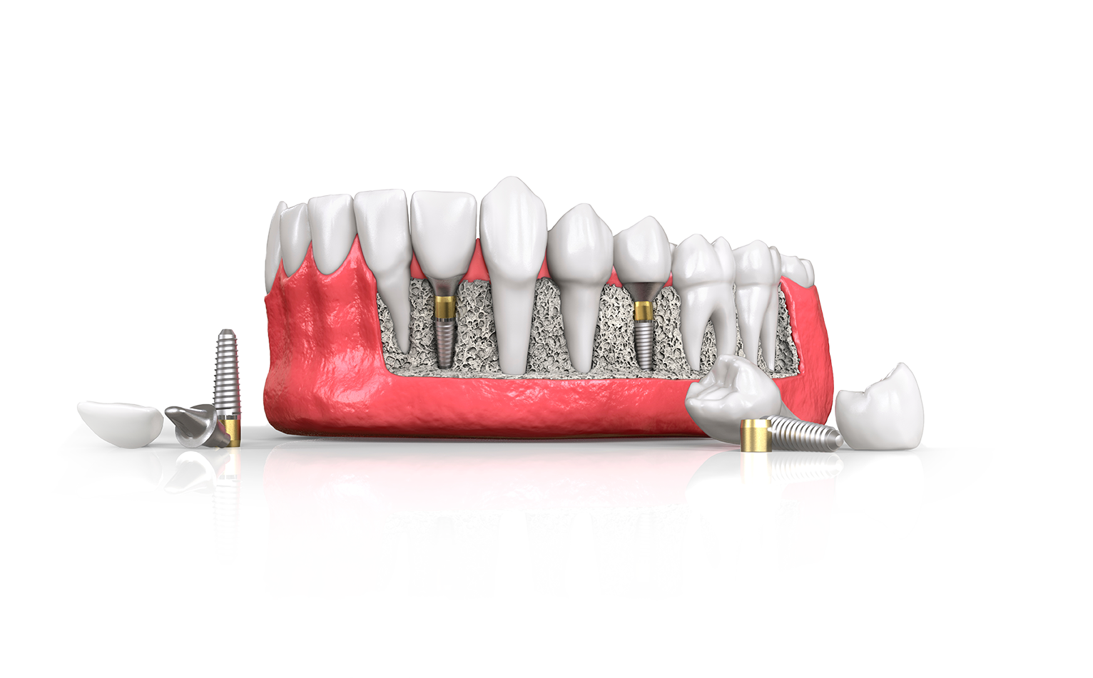 A tooth model showing bone graft a patient smiling after gum recession treatment chattanooga tn chattanooga periodontics dental implants