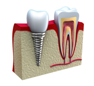 Chattanooga periodontics dental implants