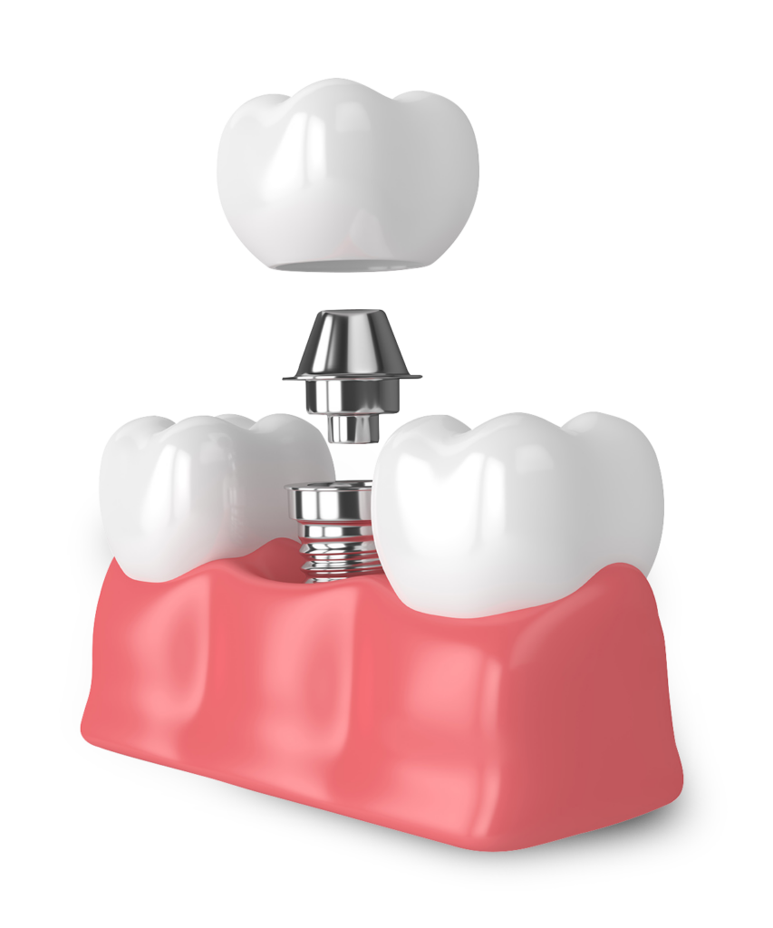 Chattanooga periodontics dental implants