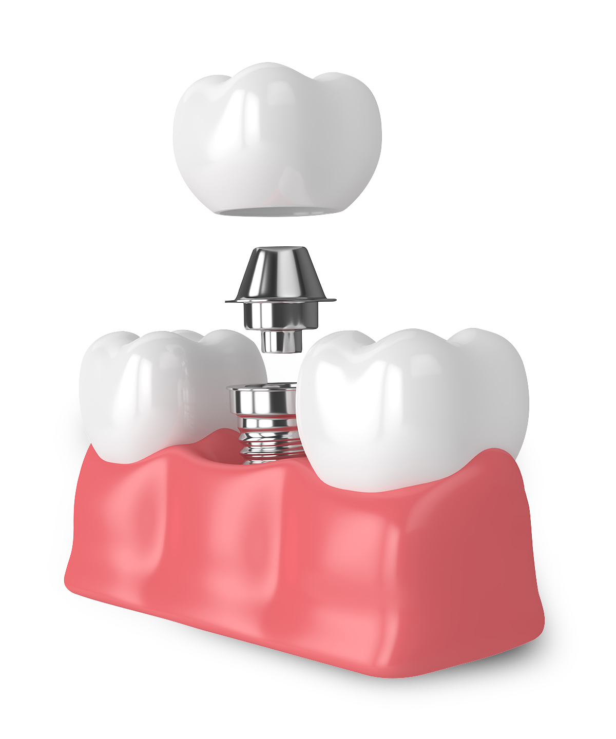 Chattanooga periodontics dental implants